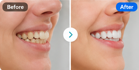 Teeth Alignment