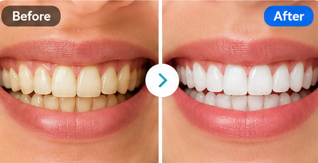 Dental Whitening